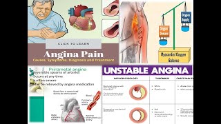 Unstable angina and Prizmetal angina pectoris in hindi [upl. by Thekla357]