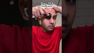 Day112 of Restoring Hairline [upl. by Ahsimot249]