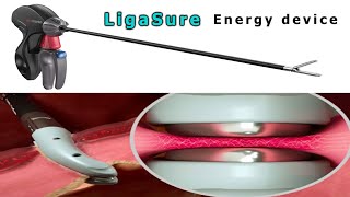 Ligasure  Bipolar energy device [upl. by Suilenrac]