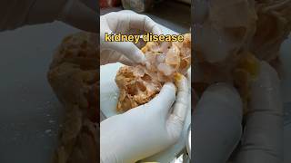 Kidney disease cystic kidney disease சிறுநீரக நோய்  biopsy endometrialpolyp kidneystone [upl. by Hecklau]