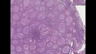 Histopathology Lymph node Follicular lymphoma grade 2 [upl. by Elletsyrk]