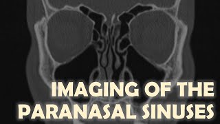 Imaging Anatomy of the Paranasal Sinuses [upl. by Lilia203]