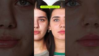 How to Treat Hormonal Acne Before amp After  eyeam 👁️ ❇️ wellness [upl. by Harned429]