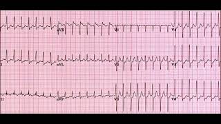 identify the rhythm  PMDC NLE NRE MD1 FCPS1 [upl. by Etolas859]