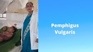 PEMPHIGUS VULGARIS Marathi pemphigus vulgaris treatment DR SMITA CHAKOTE [upl. by Martinson]