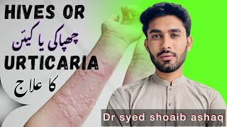 Urticaria Hives causes amp treatment in UrduHindi  kainchapaki  Dr Syed Shoaib Ashaq [upl. by Lise465]