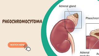 Pheochromocytoma [upl. by Kirven167]