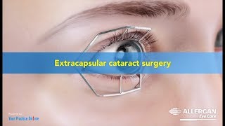 Extra Capsular Cataract Surgery  ECCE [upl. by Vokay]