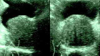 BIOPSIA DE PROSTATA GUIADA POR ULTRASONIDO [upl. by Eelnodnarb]