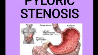 Pyloric stenosis [upl. by Lubbi413]