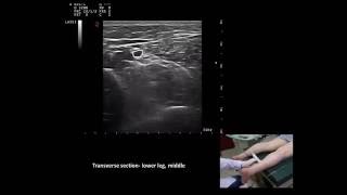 Ultrasound guided m tibialis posterior botulinum toxin injection by Murat Karkucak MD [upl. by Caassi184]