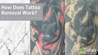 How does Picosure tattoo removal work [upl. by Dnaltiac537]