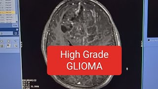 mri brain high grade Glioma Glioma in Brain [upl. by Fremont]