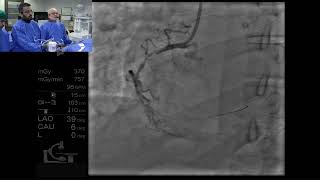 Endoluminal reconstruction of a diffusely diseased and tortuous RCA by Tejas Patel [upl. by Robina]