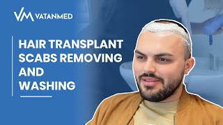 Hair Transplant Scabs Removing And Washing  VATANMED [upl. by Varhol810]