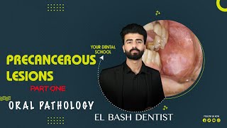 precancerous lesions  oral pathology  عزت شومان [upl. by Acirtal32]