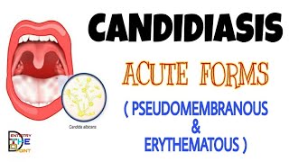 CANDIDIASIS  ACUTE FORMS  PSEUDOMEMBRANOUS amp ERYTHEMATOUS [upl. by Siurad3]