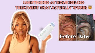 KELOID REMOVAL AT HOME THAT ACTUALLY WORKS  CLARITAG [upl. by Decima]