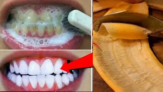 In Just 2minutes Whiten Yellow stained Teeth at Home BEST TEETH WHITENING REMEDY ll NGWorld [upl. by Hairim]