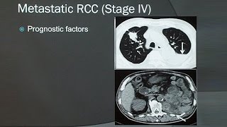 Renal Cell Carcinoma [upl. by Leafar]