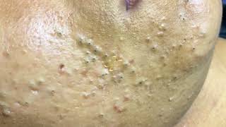 sac be spa blackheads elderly 2024 sacbe spa old age blackheads 2024 [upl. by Onibag187]