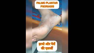 PALMOPLANTAR PSORIASIS psoriasis itching dryskin shortsfeed shortvideo shorts ytviral SHORT [upl. by Alleuqcaj]