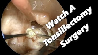 Tonsillectomy Surgery  actual footage [upl. by Etam326]