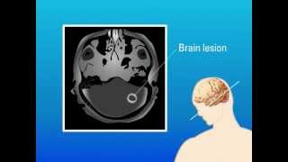 Extrapulmonary Aspergillosis – Type of Fungal Infection [upl. by Florian]