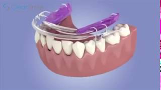 How Inman Aligner Braces Work  Glasgow Medical Center Dubai [upl. by Olinad]