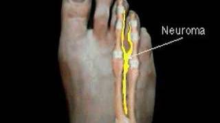 Excision of Mortons Neuroma  Surgical Animation [upl. by Khanna112]