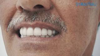 Implante Dental Peru  Prótesis sobre Implantes Dentales  Smiles Peru [upl. by Adiaros]