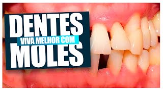 Se você tem Dentes Moles PERIODONTITE você precisa assistir esse video [upl. by Enovad383]