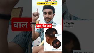 Tinea Capitis Treatment By DrHaroon Rashid Sayed  बाल तोड़ होने का इलाज [upl. by Tomas]