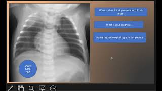 OSCE CASE 002  Pneumothorax left side and Pneumomediastinum [upl. by Zat]