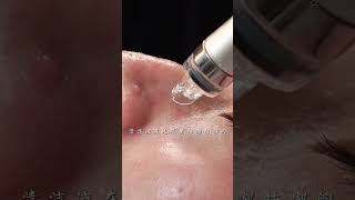 Removing the blackheads immersive skin care deep pore cleansing skin management asmr facial spa [upl. by Aicac]