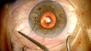 Implantación de lente intraocular de cámara anterior [upl. by Bechler670]