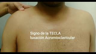 SIGNO DE LA TECLA LUXACIÓN ACROMIOCLAVICULAR [upl. by Nerdna]