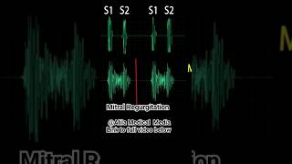 Heart Murmurs Mitral Valve Regurgitation heartmurmurs medicalanimation [upl. by Mosi]