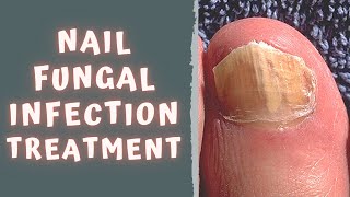 HOW TO TREAT FUNGAL NAIL INFECTION  TINEA UNGUIUM  ONYCHOMYCOSIS [upl. by Ailhad]