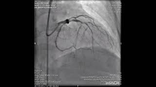 PCI to LAD CTO with diffusely diseased mid to distal vessel [upl. by Nalo]