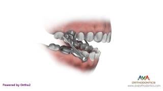 Orthodontics Treatment for Overjet Overbite  Herbst Appliance [upl. by Ruella387]