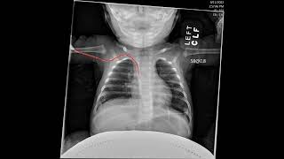 Peripherally Insert Central Venous Catheters PICCs  Pediatric Radiology and NICU [upl. by Aloek230]