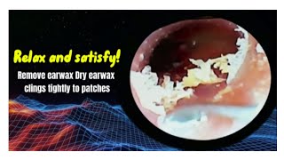 Remove dry earwax that sticks together in layers [upl. by Acireh]