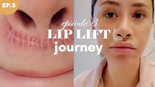 LIP LIFT SURGERY 💉 Episode 3  This scar is not healing right [upl. by Daahsar692]