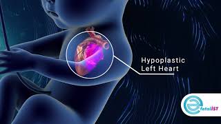 Hypoplastic left heart syndrome HLHS [upl. by Tully]