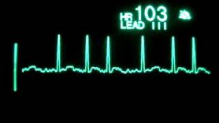 Atrial Fibrillation [upl. by Shay999]