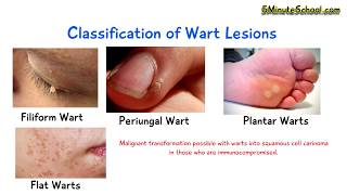 What is a Wart Human Papilloma Virus EXPLAINED IN 3 MINUTES Cause Diagnosis CLASSIFICATION [upl. by Pincus]