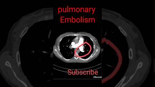 Pulmonary Embolism shorts radiology [upl. by Derdlim]