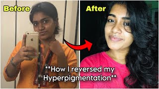 How I Reversed My Hyperpigmentation With Products Details [upl. by Ileana]