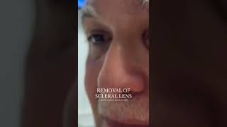 Removing Scleral Lenses [upl. by Macri550]